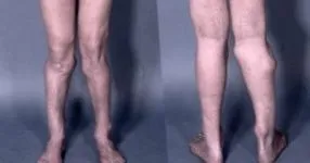 exostosisok