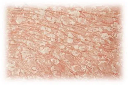 Görgő peeling arc, típusok, jelzések és ellenjavallatok