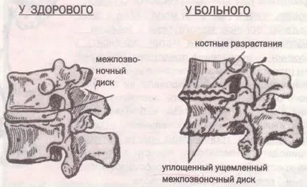 Spondylosis nyaki gerinc tünetek, a kezelés (a tünetek) Spondylosis nyaki gerinc tünetei, kezelése