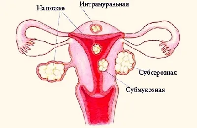 Subserous egység működését a méhben, vagy sem, a tünetek és a diagnózis (csomópont) Subserous egység működik a méhben, vagy sem, a tünetek és diagnózis