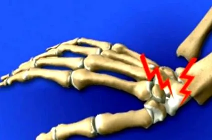 törések osteoporotikus