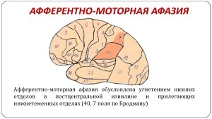 Minden következményét az ischaemiás stroke - részletes leírása (Depresszió stroke után) Minden következményét az ischaemiás stroke - részletes leírása