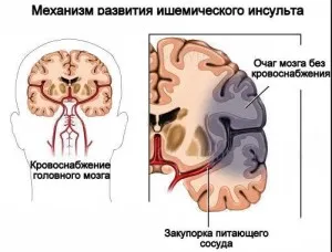 Minden következményét az ischaemiás stroke - részletes leírást (ischaemiás) Minden következményét az ischaemiás stroke - részletes leírása