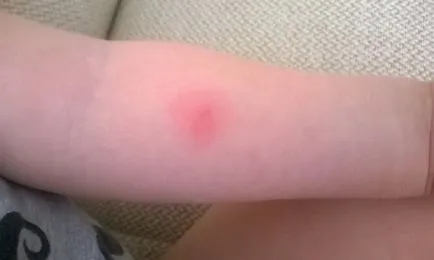 Miért, hogy a Mantoux teszt