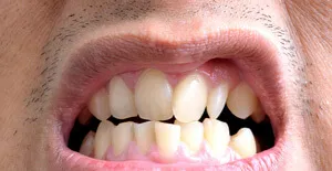 19 A lehetséges hatásai malocclusion
