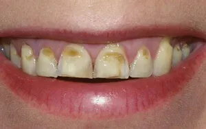 19 A lehetséges hatásai malocclusion