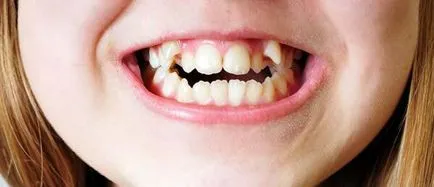 19 A lehetséges hatásai malocclusion