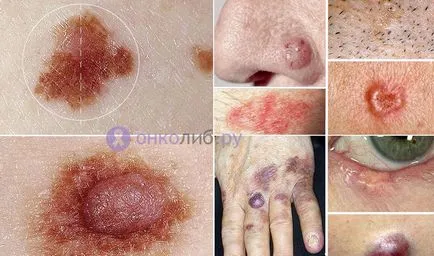 A bazális sejtes karcinóma bőrtünetek, kezelési és eltávolítási, fotó (bőr) A bazális sejtes karcinóma bőrtünetek, kezelési és eltávolítási, fotó