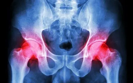 hip arthritis népi jogorvoslati gyógyítani