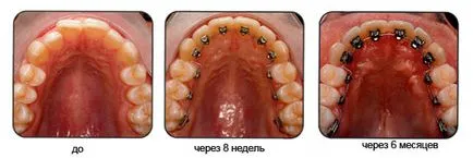 Melles különböző rendszerek, fotó felszerelése előtt és után