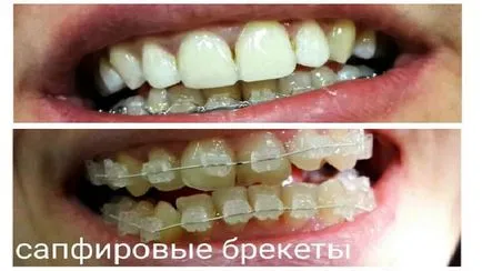 Nadrágtartók - fotók előtt és után összehangolását malocclusion (fotó) Nadrágtartók - fotók előtt és után összehangolását malocclusion