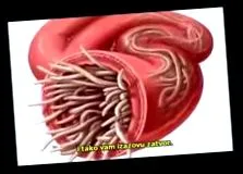 giardia