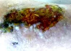 labdiabetikus giagrena