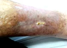 giagrena labdiabetikus
