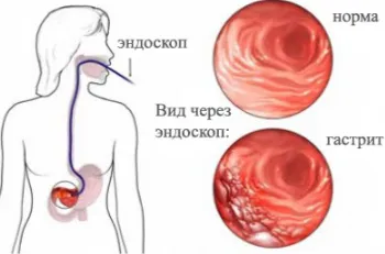 FGS gyomor hogyan is végezzük, előkészítés, olvasás, az árak (folyamatban) FGS gyomor hogyan is teljesített, a képzés, felolvasások, árak