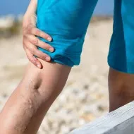 Flebolity a medence és a lábak okok, kezelés, a tünetek (láb) Flebolity a medence és a lábak okok, kezelés, a tünetek