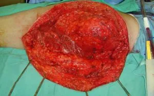 Fibroszarkóma fotó, a betegség okait, a tünetek, hatékony kezelések (lágyrész fibroszarkóma) Fibrosarcoma fotó, a betegség okait, tüneteit, hatékony kezelés