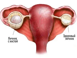 A tüszők a petefészekben a menopauza okoz jelentős változásokat (menopauza) A tüszőket a petefészekben a menopauza a fő oka a változások