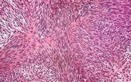 Fibroszarkóma fotó, a betegség okait, a tünetek, a hatékony kezelés (tünetek) Fibrosarcoma fotó, a betegség okait, tüneteit, hatékony kezelés