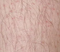 Hyperkeratosis - okai, tünetei, diagnózisa és kezelése