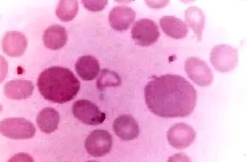 Méretének változtatása vörösvértestek microcytosis, macrocytosis, megalotsitoz, shizotsitoz, anisocytosissal