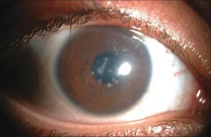Hogyan kell kezelni retinadisztrófiában hatékony módszerekkel (retina) Hogyan kezelik a retinadisztrófiában szemét hatékony módszerek