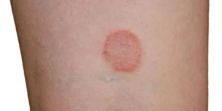 Ahogy továbbított versicolor - kórokozó inkubációs időszak, mind kezdődik és megelőzésére (övsömör) Hogyan zoster - kórokozója, a lappangási idő, és a megelőzés kezdődik