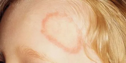 Ahogy továbbított versicolor - patogén inkubációs időszak, elindul, és a megelőzés (telt) Hogyan zoster - kórokozója, a lappangási idő, és a megelőzés kezdődik