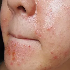 Hogyan nyilvánul allergia tüneteit az arckrém, hogy mi a teendő ilyen esetben - minden, ami allergia