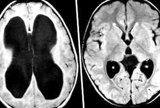 betegségek hydrocephalus