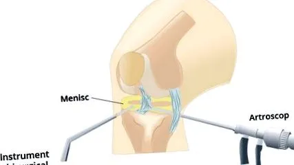 hematoma térdén