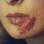 Keloids kezelési szakasz okok és