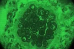 Kullancsencephalitis tüneteket, megelőzésére és kezelésére