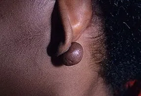 Keloids kezelési szakasz okok és