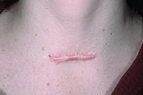 Keloids kezelési szakasz okok és