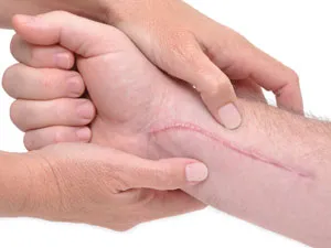 Keloids oka a kialakulását, kezelési és eltávolítási keloidos hegek, módszerek