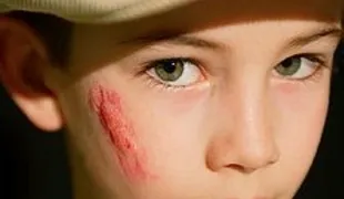 Keloids kezelési szakasz okok és