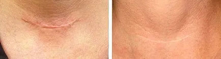 Keloids oka a kialakulását, kezelési és eltávolítási keloidos hegek, módszerek