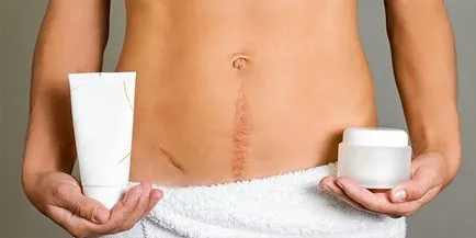 Keloid heg képződés okai, kezelési és eltávolítási hegek (képződés) Keloid heg képződés okai, kezelési és eltávolítási hegek