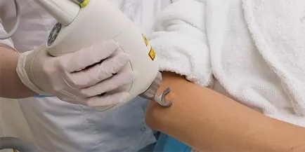Keloid heg képződés okok, kezelés, és eltávolítása heg (keloid heg) Keloid heg képződés okai, kezelési és eltávolítási hegek