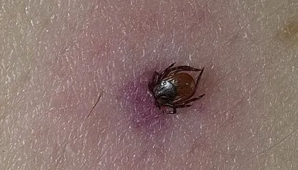 Kullancsencephalitis tünetek, kezelés, prognózis