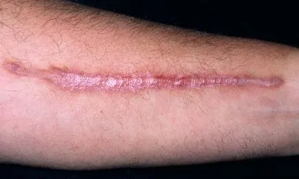 Keloids kezelési szakasz okok és