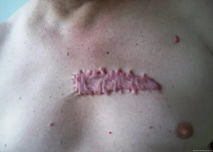 Keloids kezelési szakasz okok és