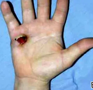 emberi papilloma vírus
