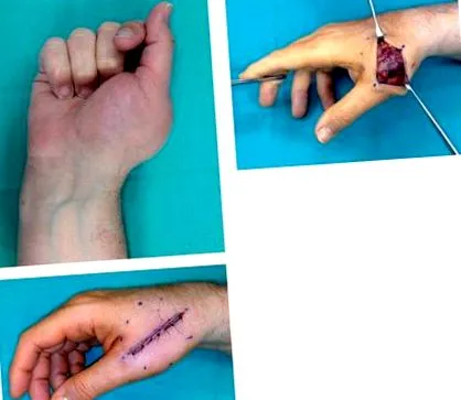 papilloma vírus szemölcsök