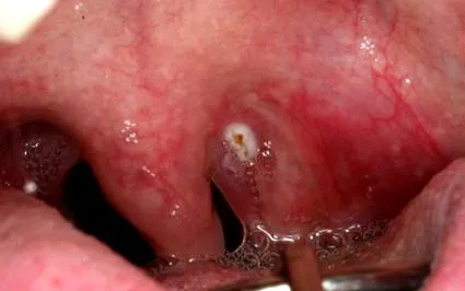 papilloma uvula