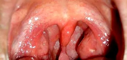 uvula