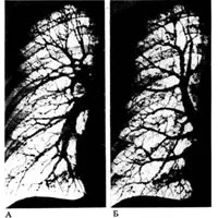 Pulmonalis törzs 1