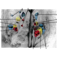 Pulmonalis törzs 1