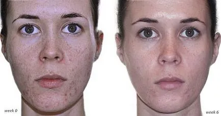 mandula peeling